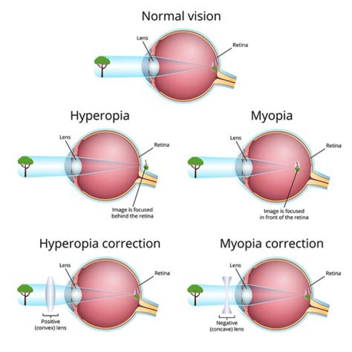 Is myopia concave or convex