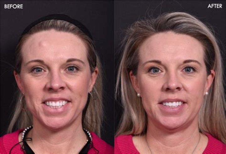 Is osteoma surgery painful