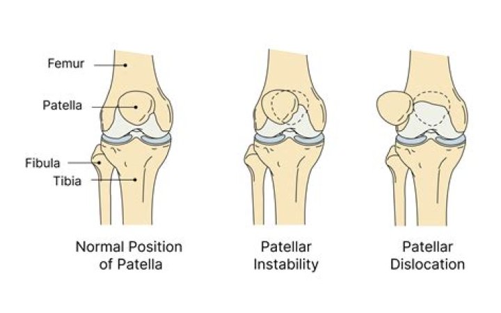 Is patellar subluxation bad