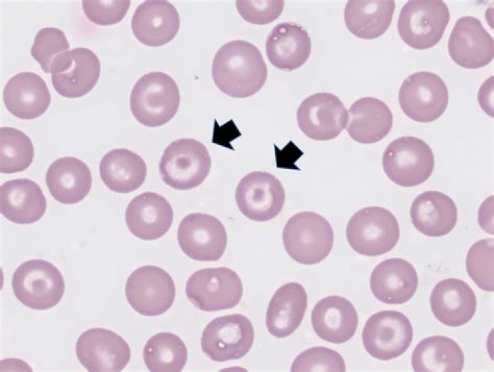 Is poikilocytosis a cancer