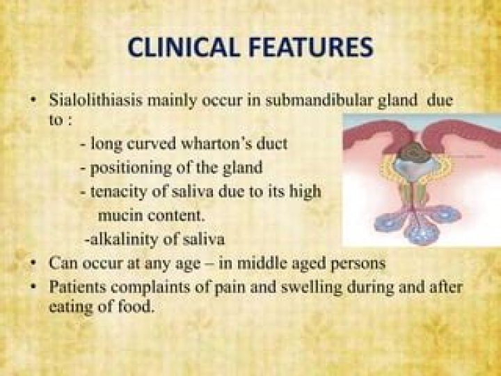 Is Sialolithiasis dangerous