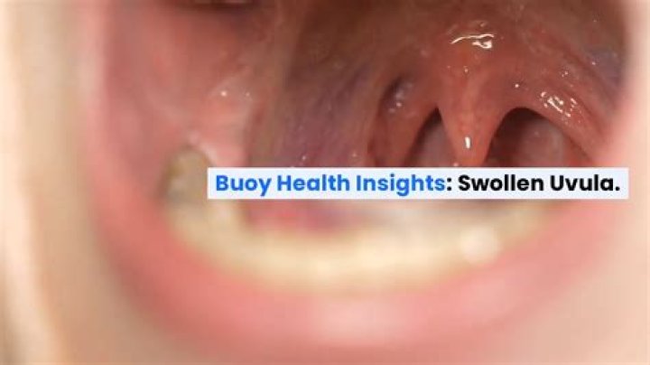 Is swollen uvula contagious