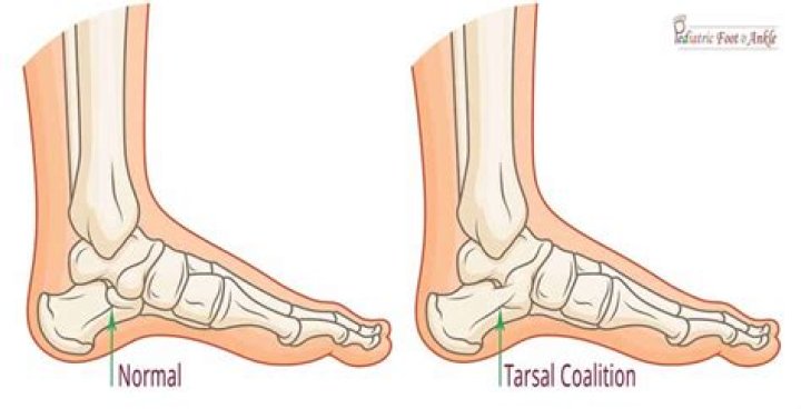 Is tarsal coalition serious