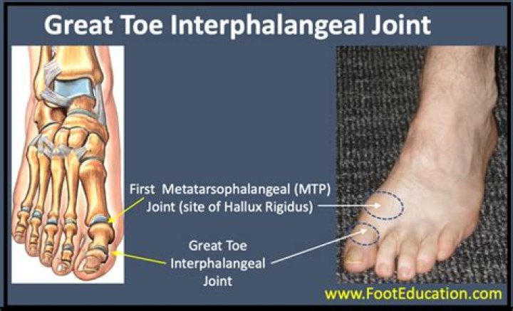 Is the toe a gliding joint
