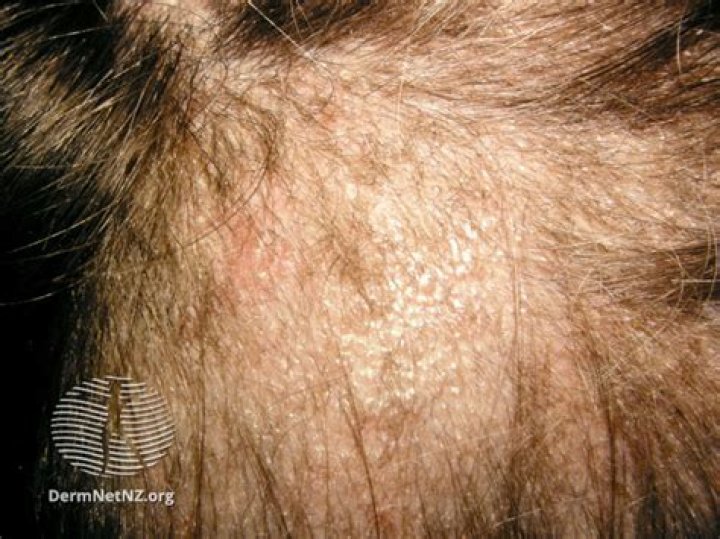 Is tinea capitis a parasite