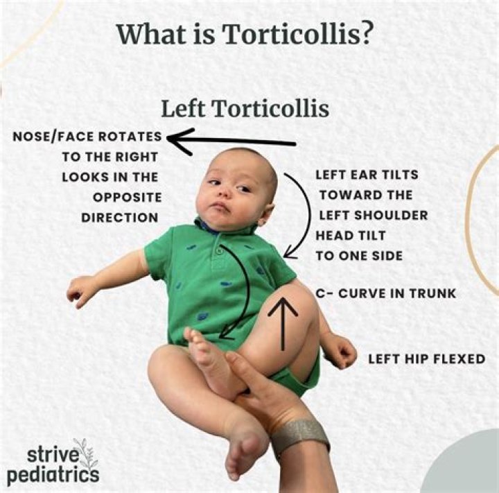 Is torticollis a disability