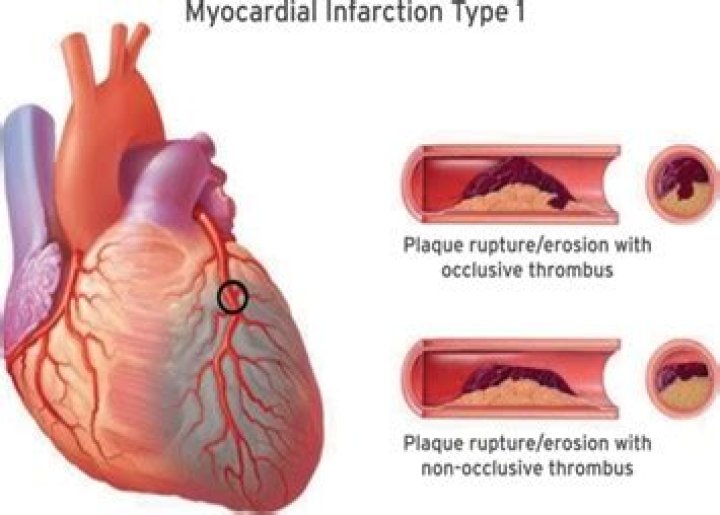 Is type 2 mi a heart attack