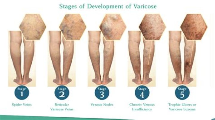 Is venous reflux hereditary