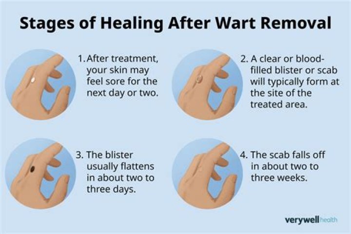 Is wart removal covered by Medicare