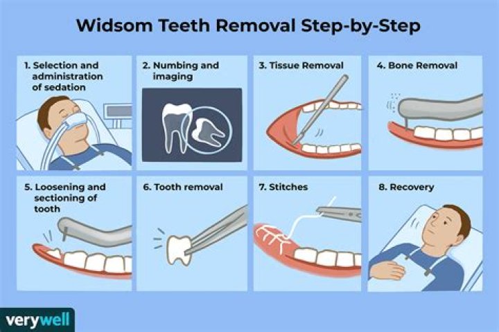 Should wisdom teeth be removed