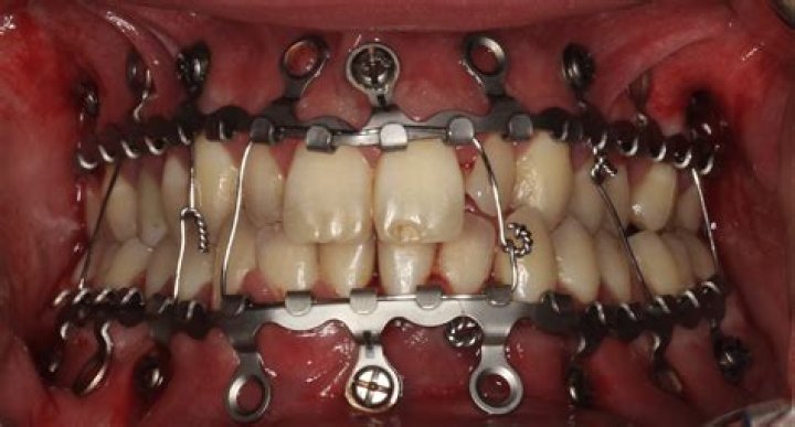What are arch bars used for