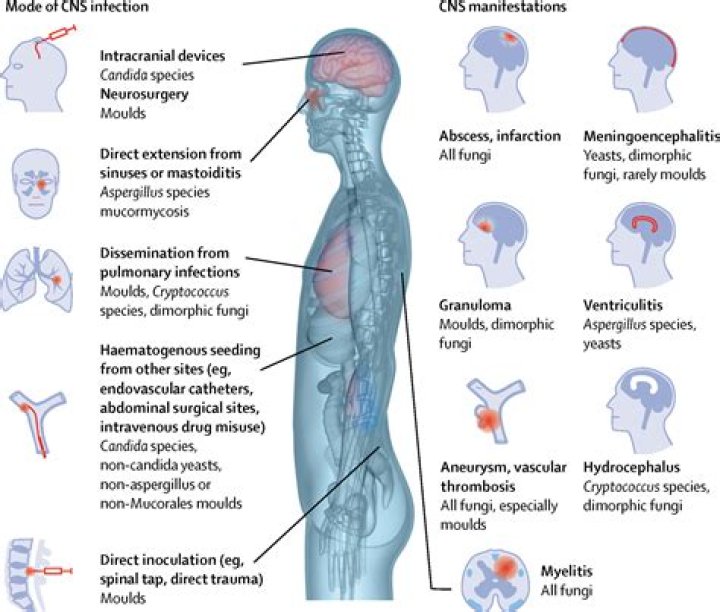 What are CNS symptoms