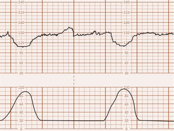 What are early decelerations