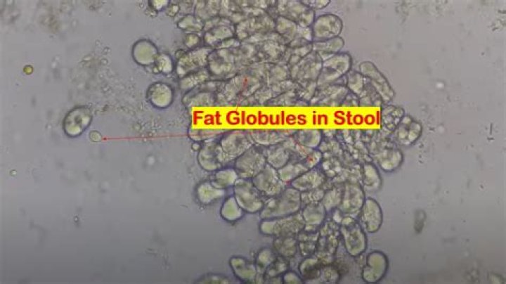 What are fat globules stool