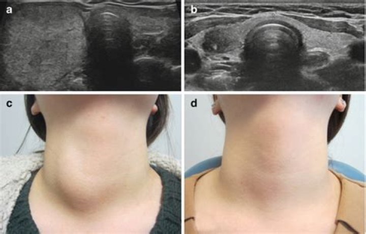 What are nodules in thyroid