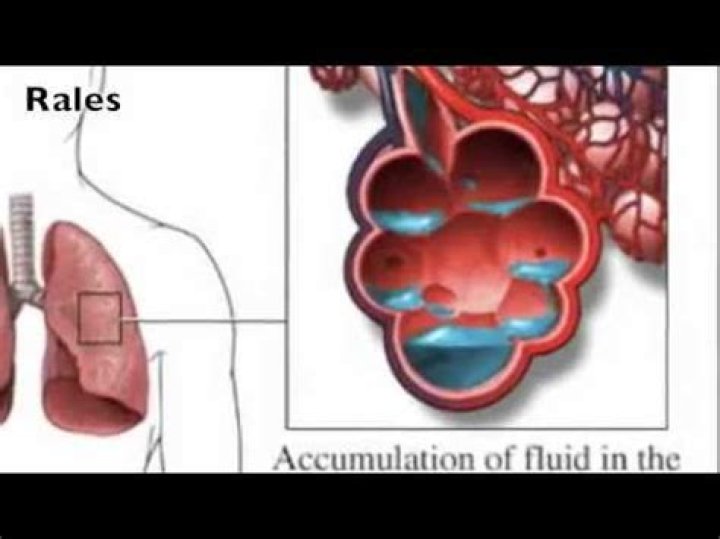 What are Rales in the lungs