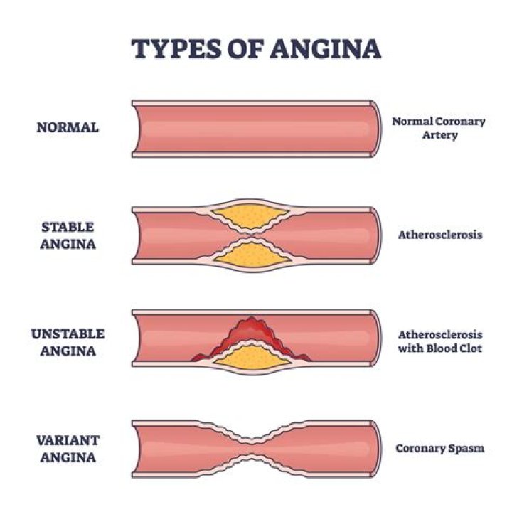 What are the 4 E of angina