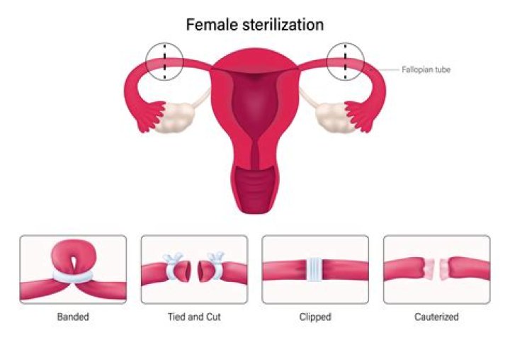 What are the different methods of tubal ligation