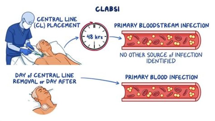What are the major risks of a central line intravenous catheter