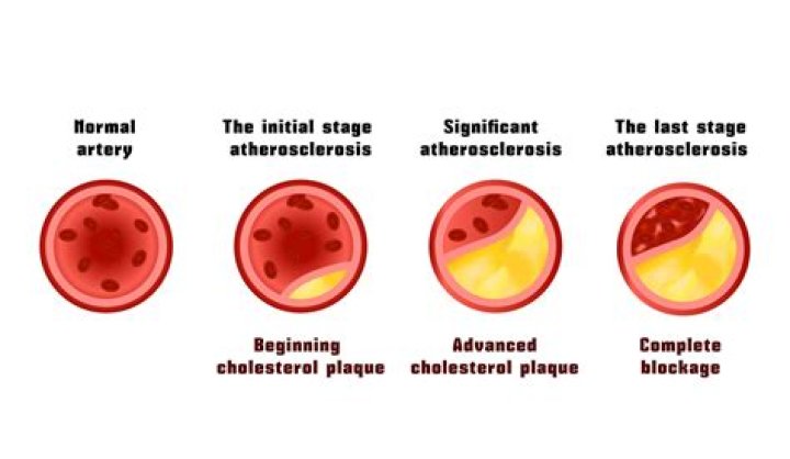 What builds up on the inside walls of arteries