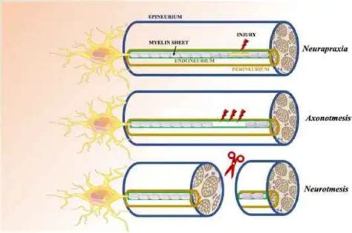 What can cause neurotmesis