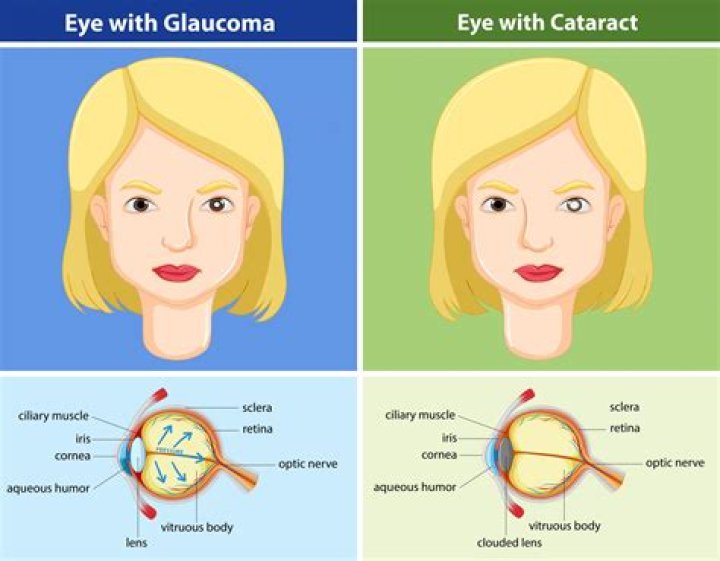 What causes a cataract to grow fast