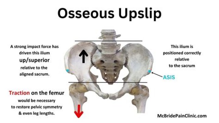What causes a pelvic Upslip