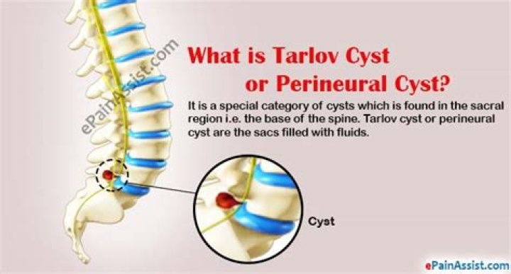 What causes a perineal cyst