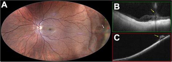 What causes a retinal tuft