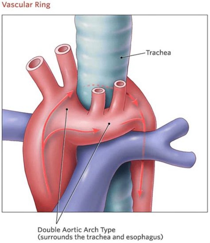 What causes a vascular ring