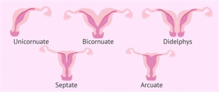 What causes abnormally shaped uterus