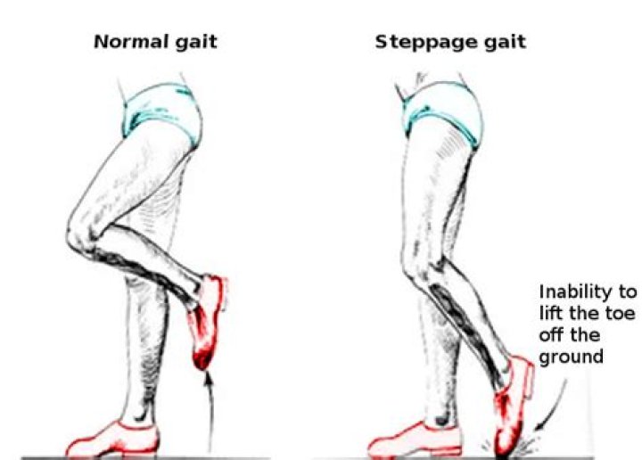 What causes an ataxic gait