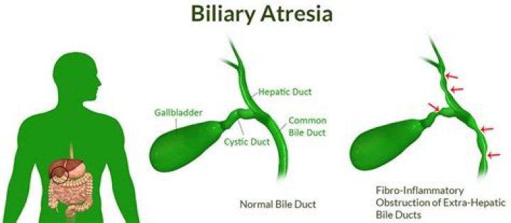 What causes biliary atresia