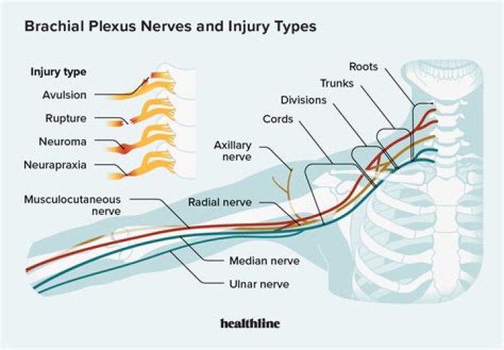 What causes brachial plexus