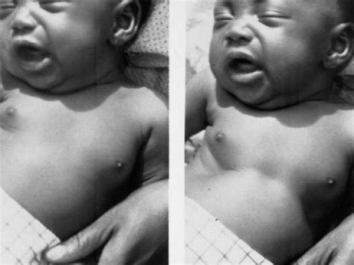 What causes chest Indrawing