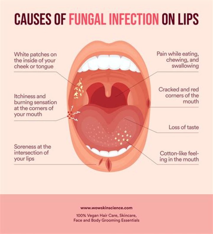 What causes fungus in mouth