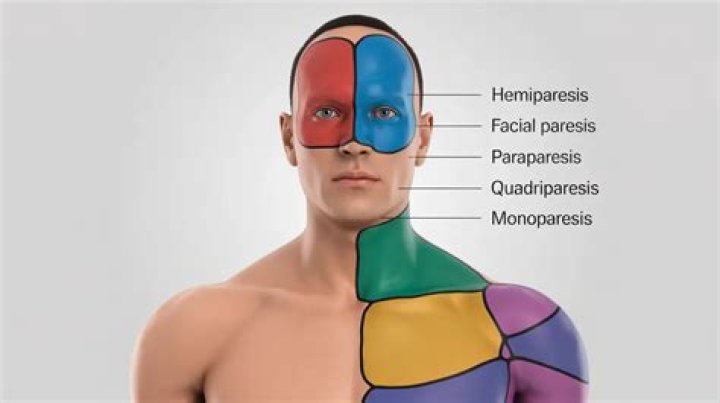 What causes general paresis