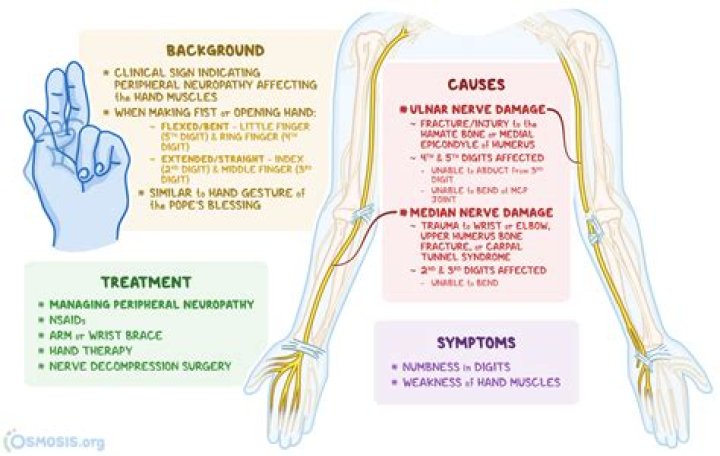 What causes hand of benediction