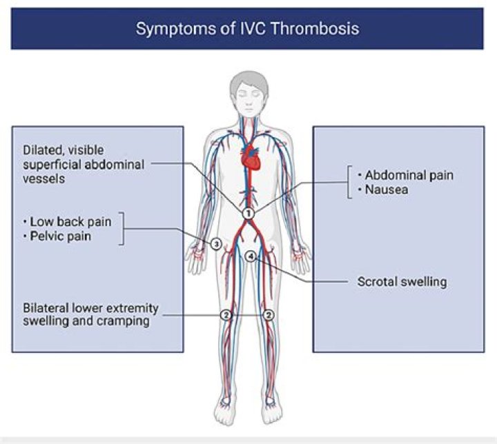 What causes IVC thrombosis