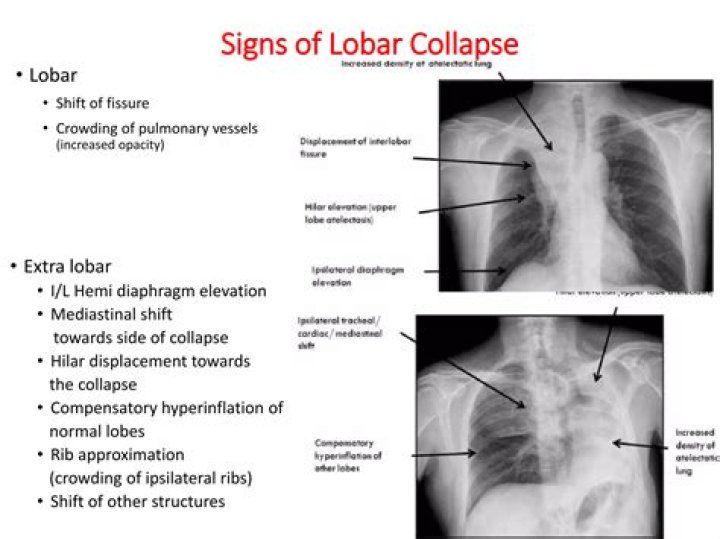 What causes lobar collapse