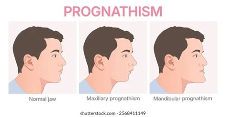 What causes mandibular Prognathism
