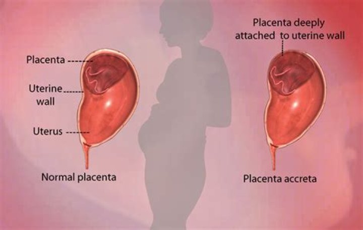 What causes placenta accreta