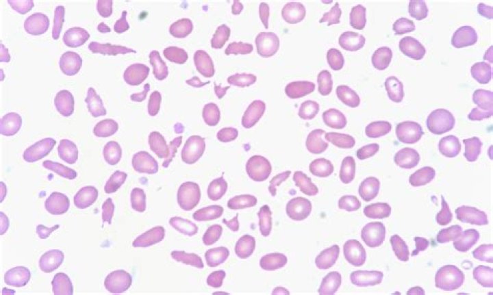 What causes Poikilocytosis