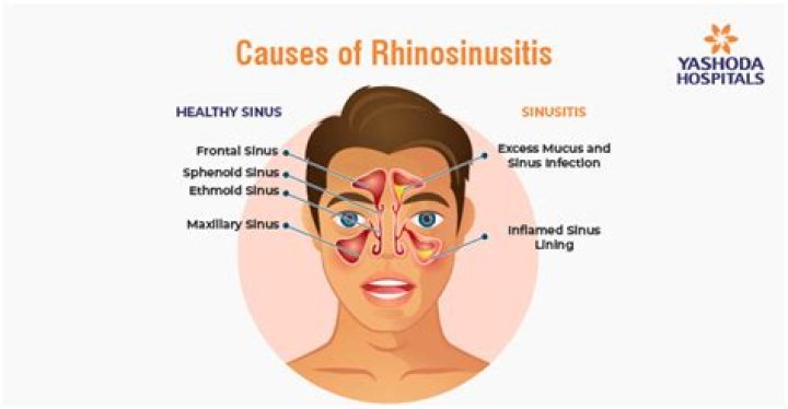 What causes rhinosinusitis