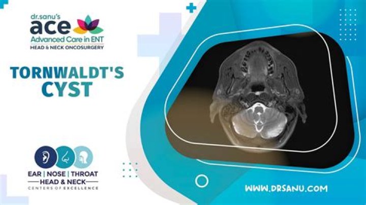 What causes Thornwaldt cyst