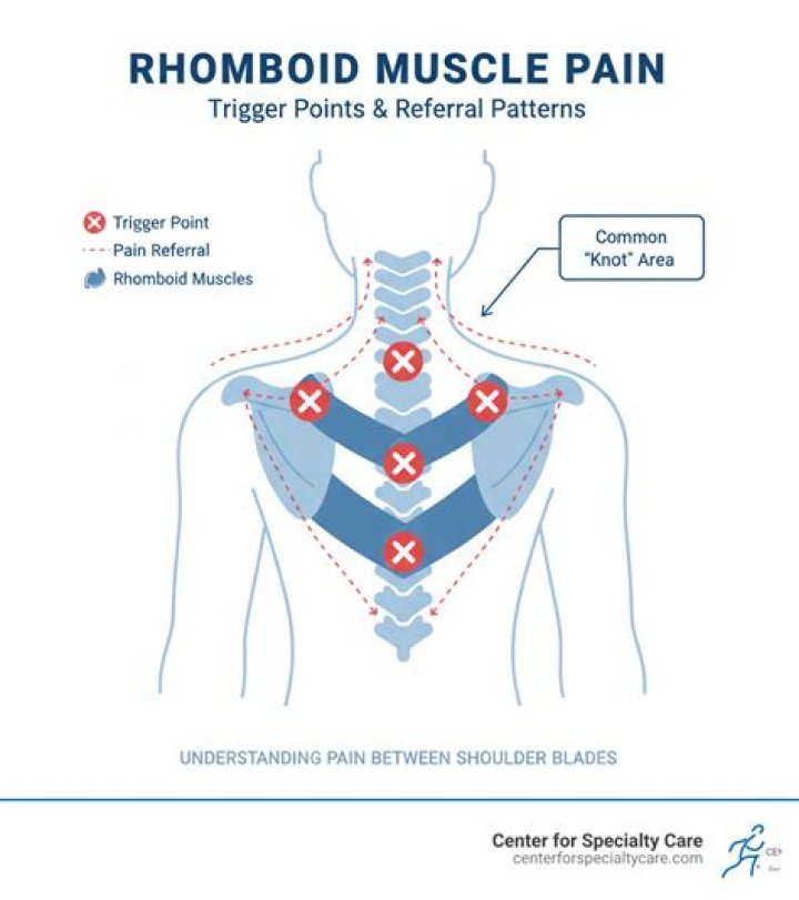 What causes tight rhomboids