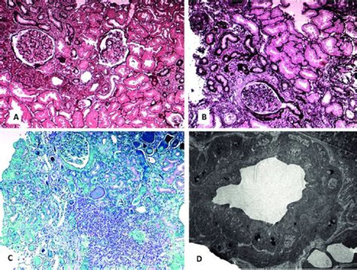 What causes tubular atrophy