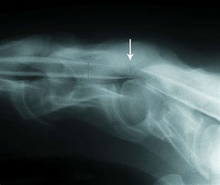 What causes wobblers in horses