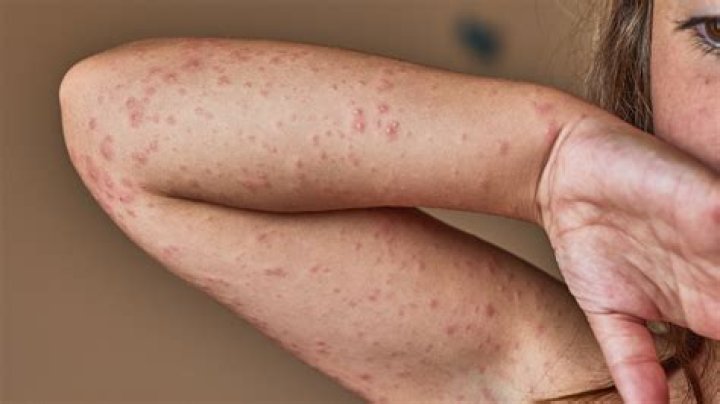 What do you do if your allergic to antibiotics