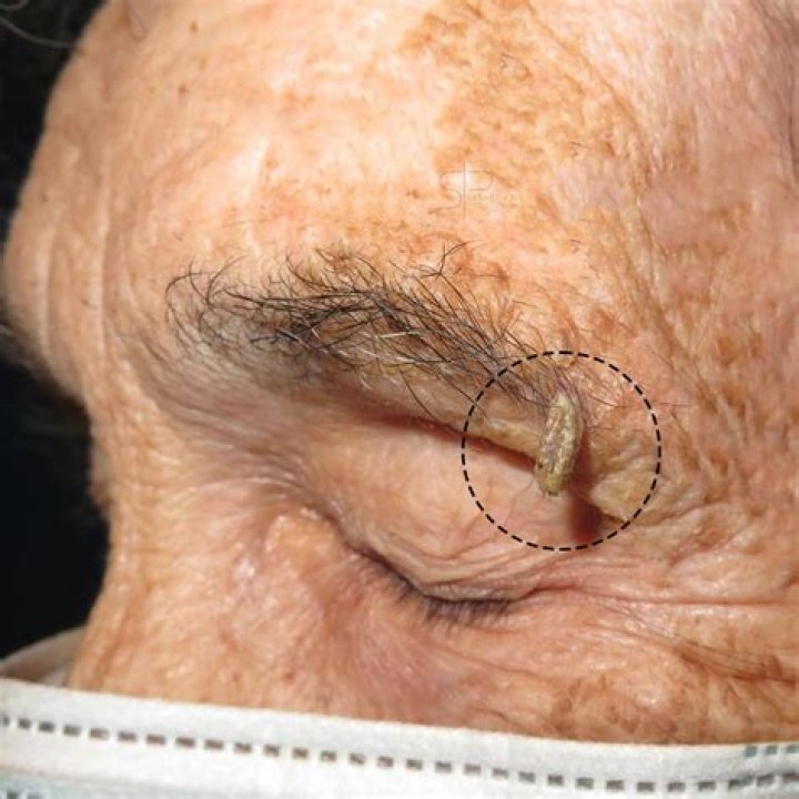What does a cutaneous horn look like